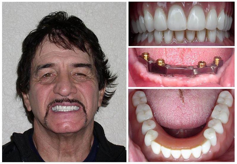 tooth implant before and after