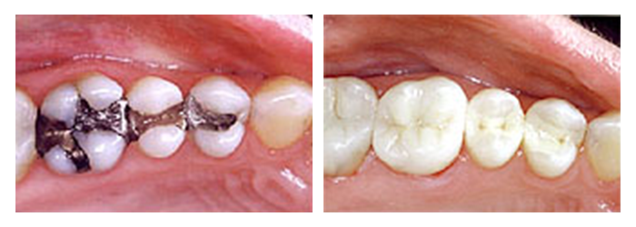 Before and After comparison of amalgam fillings vs. composite fillings